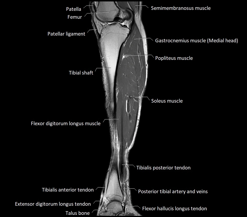 Lower leg sagittal anatomy 3T MRI image 21.webp